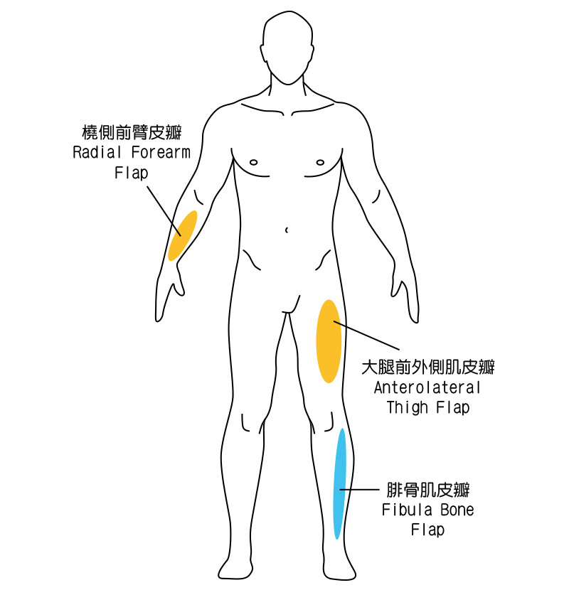 口腔癌重建皮瓣的三個取皮位置：橈側前臂皮瓣、大腿前外側肌皮瓣及腓骨肌皮瓣