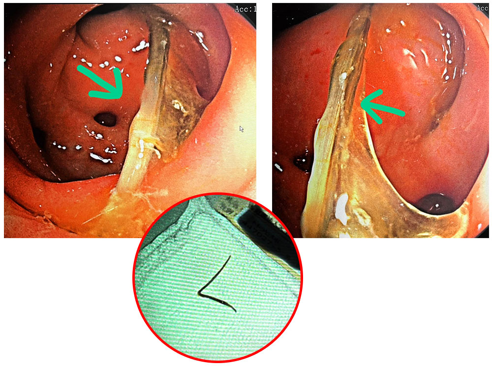 魚刺竟卡大腸 差點造成腸穿孔